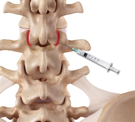 Facet Syndrome | Lumbar & Cervical Arthrosis Joint Pain Neck Arthritis, Spondylolisthesis ...