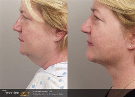 Smartlipo Triplex™ can target the jowls, neck, thighs, stomach, chest, and face. Carolina Laser ...