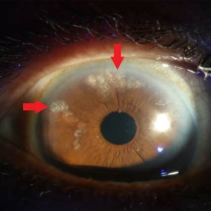 Six months after cataract surgery in the right eye. Note the LPI scars ...