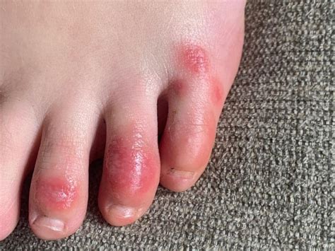 Coronavirus: COVID toes among unusual symptoms of infection | Cairns Post