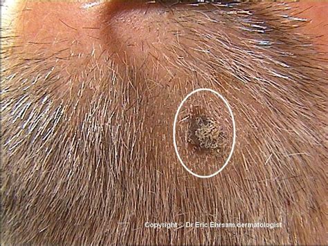 dermoscopy: Seborrheic keratosis (keratotic subtype)