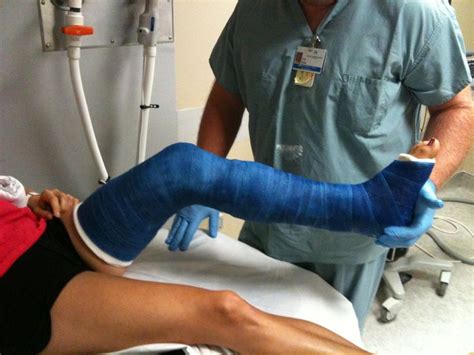 28 best images about Broken bones on Pinterest | Buzz lightyear, Take a shower and Crutches