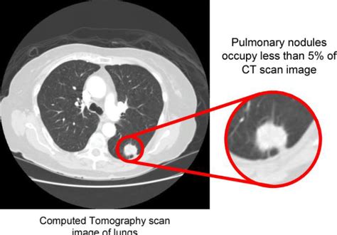 Can Lung Nodules Turn To Cancer?