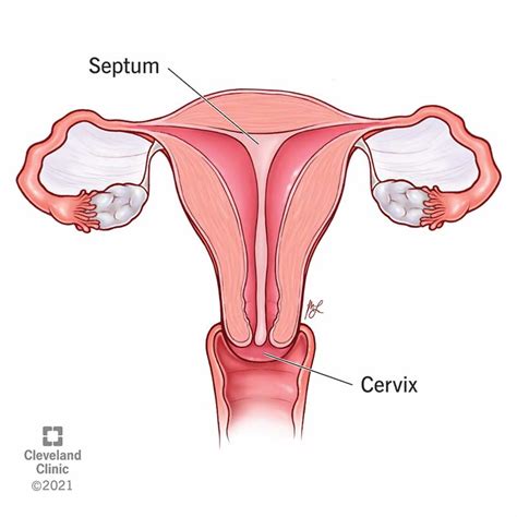 Septate Uterus (Uterine Septum): Symptoms & Treatment