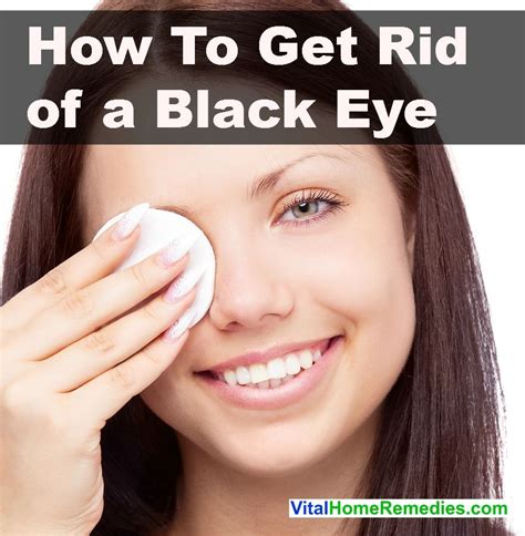 How to Get Rid of a Black Eye | Vital Home Remedies | Black eye remedies, Bruises remedy, How to ...