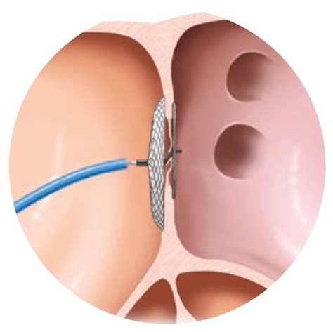 Amplatzer PFO Occluder | PFO Closure Device