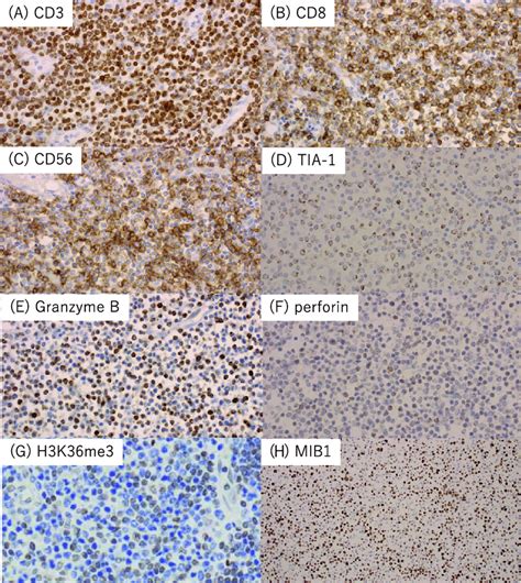 Immunophenotypes of lymphoma cells. Lymphoma cells are positive for CD3 ...