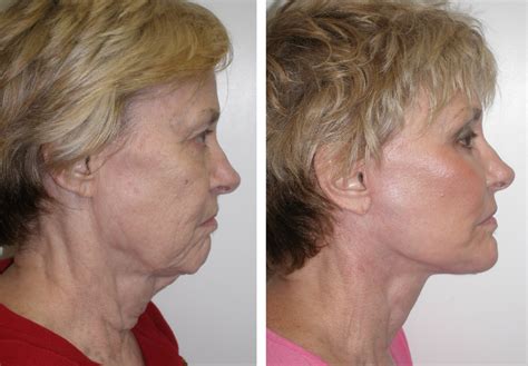 Facelift Richmond | Face Lift | Neck Lift Richmond VA | Cosmetic Facial Plastic Surgery