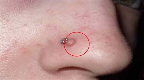 how to get rid of nose piercing bump with toothpaste - YouTube