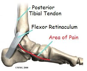 Foot Arch Pain: Causes & Treatment - Foot Pain Explored