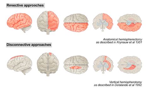 Illustration Methoden Hemisphärektomie - MedicalGraphics