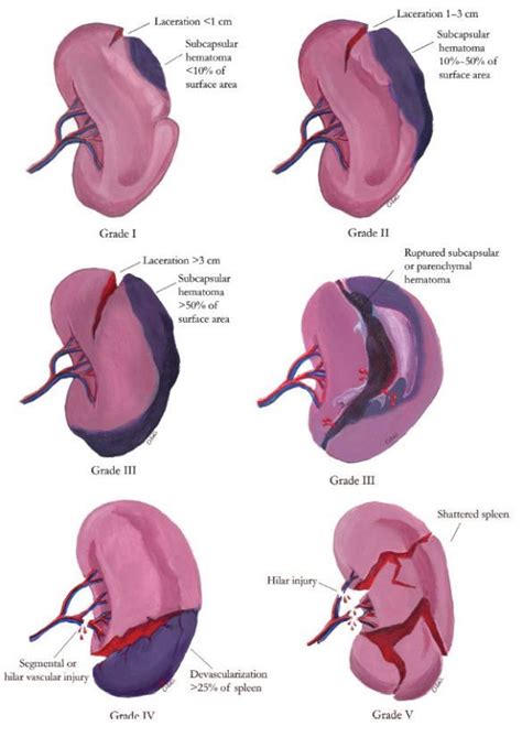 AAST Splenic Injury Grading | Radiology, Radiology imaging, Diagnostic ...