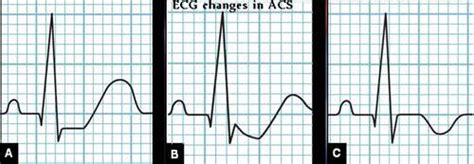 Acute Coronary Syndrome or ACS – Medchrome