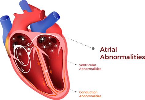 Atrial Fibrilliation (AFib) & Cardiomyopathy - symptoms & treatment