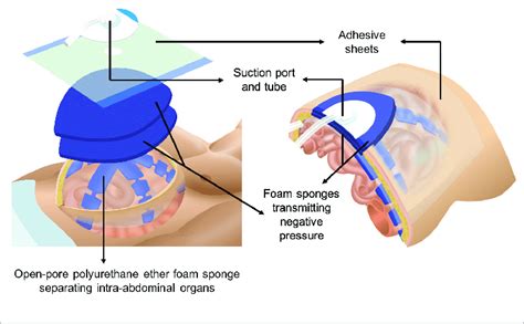 ABThera™ VAC System. This negative pressure dressing contains an... | Download Scientific Diagram