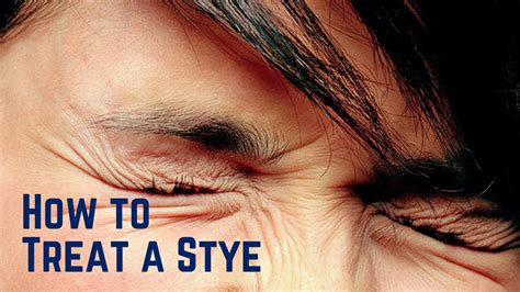 how to treat a stye in your eye - YouTube