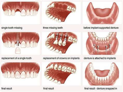 Meulener Dental of Little Silver | Mini Implants