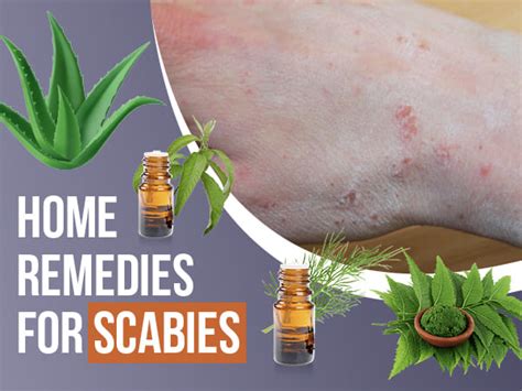 9 Home Remedies That Can Help Treat Scabies - Boldsky.com