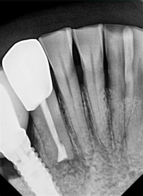 Root Canal Apicoectomy - Before & After Pictures - THE FAVOUR DENTAL - DEMO