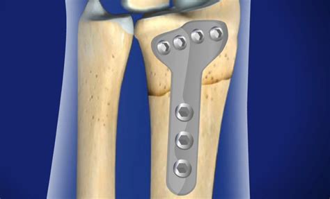 Distal Radius Fracture Repair Surgery