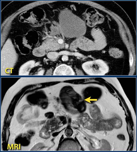 The Radiology Assistant : Acute Pancreatitis