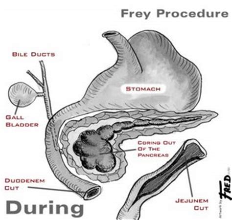 Surgeries for Pancreatitis: Frey Procedure and Distal Pancreatectomy