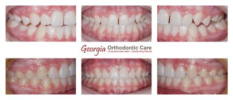 How To Treat Crossbite In Adults