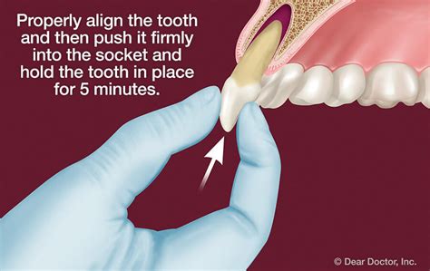 Dislodged Tooth | New York, NY | Advanced Endodontics Of New York