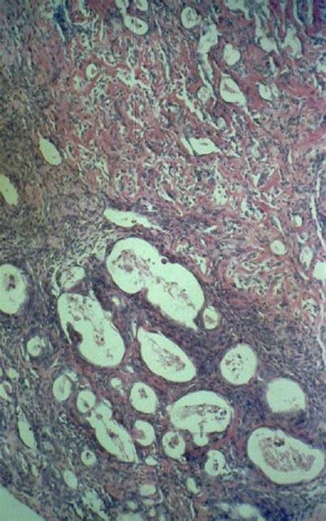 Soft Tissue Sarcoma - Pathology - Orthobullets