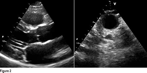 Figure 2 from Right-sided aortic arch with aberrant left subclavian ...