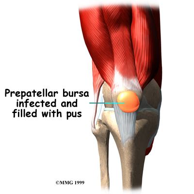 Physical Therapy in Columbia for Knee Pain - Prepatellar Bursitis