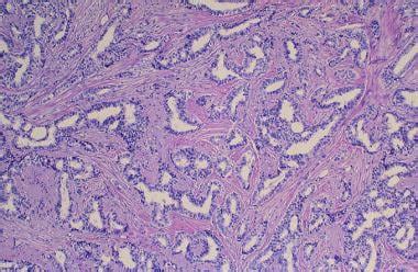 Invasive Ductal Carcinoma Histology