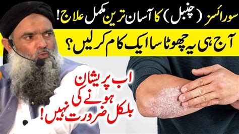 Psoriasis Treatment in Urdu | Psoriasis Ka ilaj | Psoriasis Scalp Removal Dr Sharafat Ali New ...