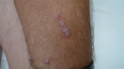 ACD A-Z of Skin - Lichen planus