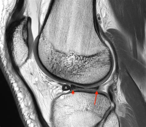 Bucket-handle Tear of the Meniscus - Radsource