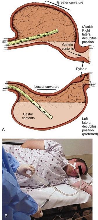 Decontamination of the Poisoned Patient | Veterian Key