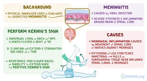 Kernig's Sign: What Is it, How It’s Used, and More | Osmosis