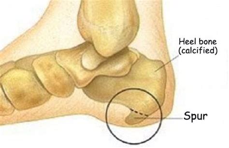 Symptoms of Heel Spurs and Treatments - Step To Health