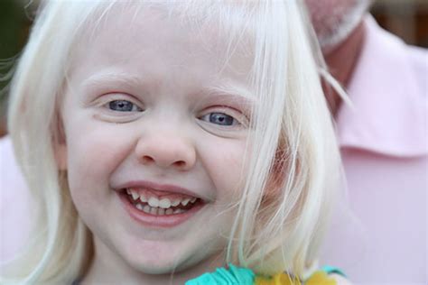 Albinism definition, causes, symptoms, diagnosis, treatment & prognosis