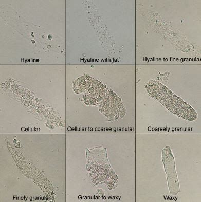 Hyaline Casts in Urine - High, Clinical Significance, Examination