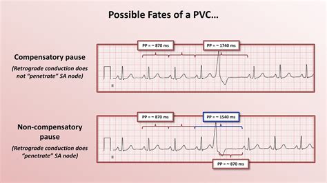 Premature Atrial Contraction Vs Premature Ventricular Contraction