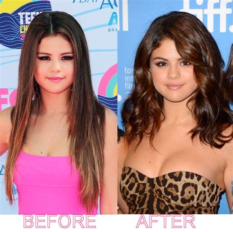 Selena Gomez Plastic Surgery Before and After: Breast Implants and Lip ...