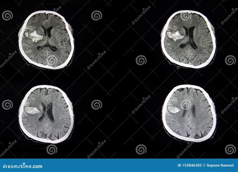 CT Scan of a Brian of a Patient with Acute Hemorrhagic Stroke Stock Image - Image of bone ...