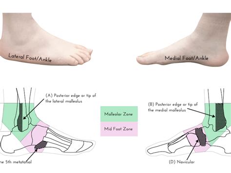 Fracture Broken Ankle Sprain