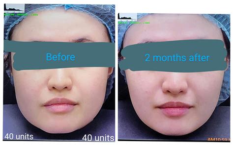 Masseter Botox before/after! (More pics in comments) : r/PlasticSurgery