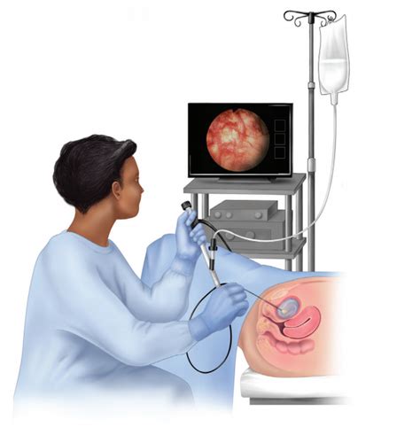 Cystoscopy - Brazosport Women's Health