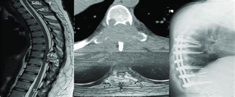 Case no. 2: T8 mainly posterior arch lytic lesion eroding lamina,... | Download Scientific Diagram