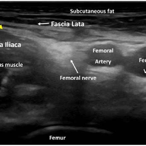 Ultrasound image of landmarks in infrainguinal fascia iliaca... | Download Scientific Diagram