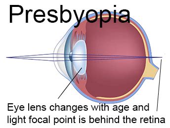 Presbyopia | Jamison Optical