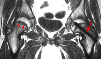 Slipped Capital Femoral Epiphysis | Radsource